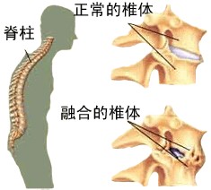 南京治疗强直性脊柱炎哪家好